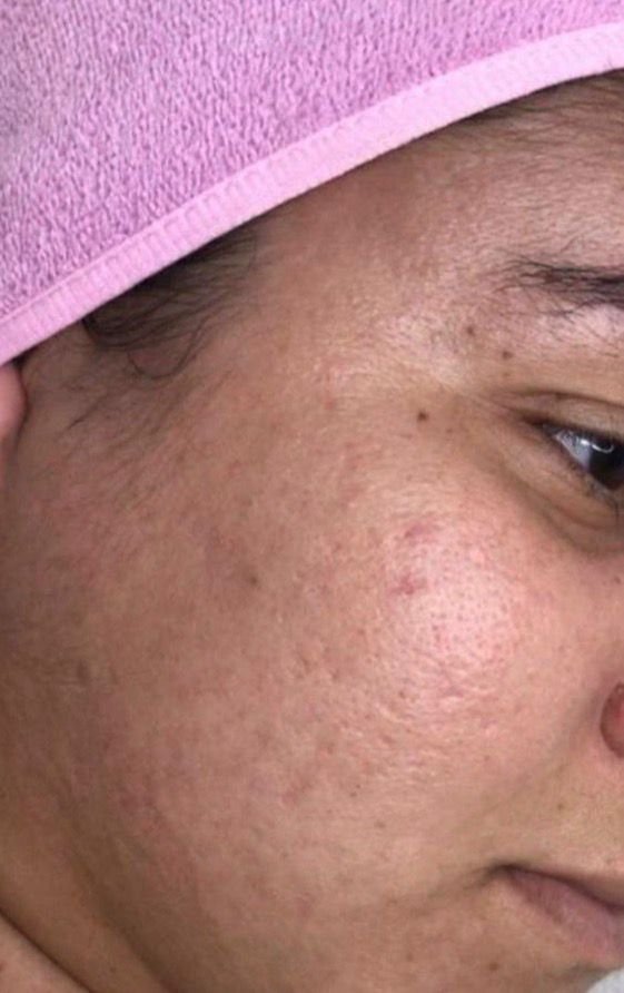 Depois do tratamento para acne