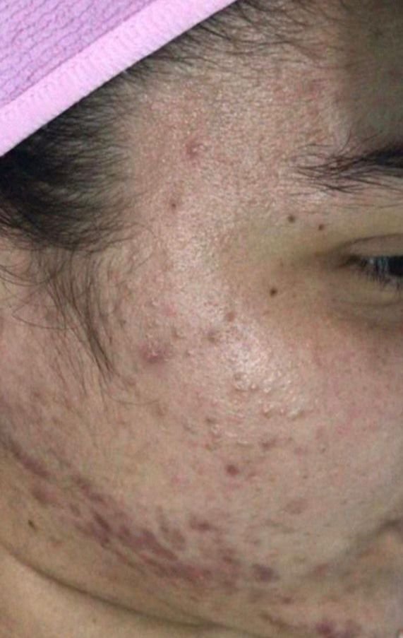 Antes do tratamento para acne